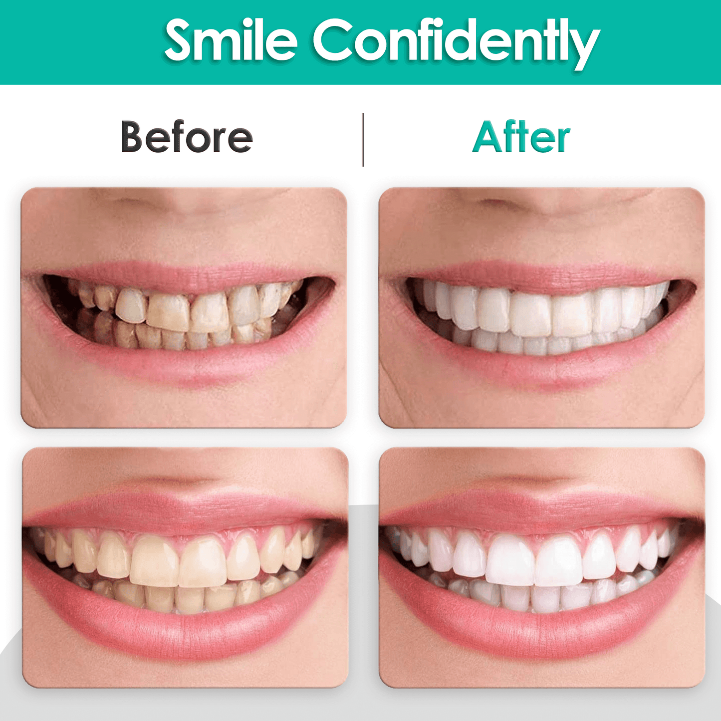 SnapOn Dental Veneers