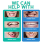 SnapOn Dental Veneers