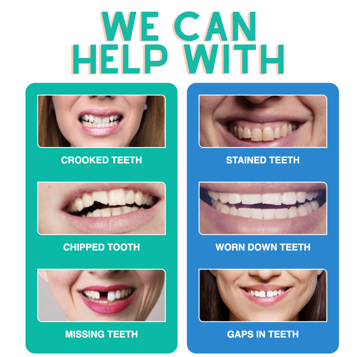 SnapOn Dental Veneers