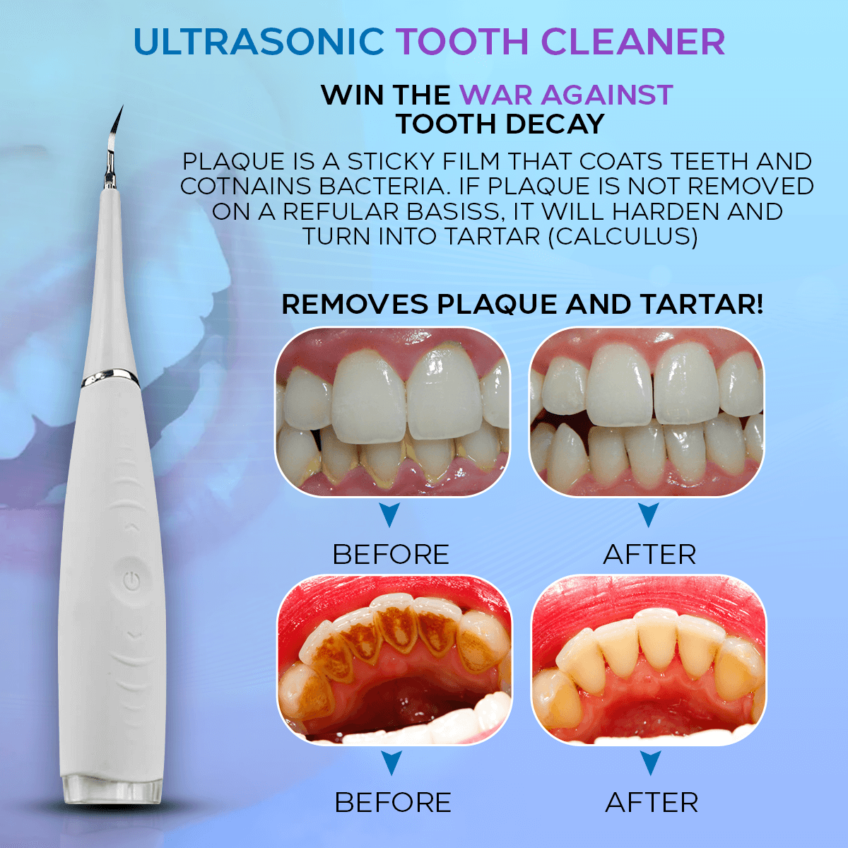 Ultrasonic Tooth Cleaner - Plaque Remover - Smile Therapy